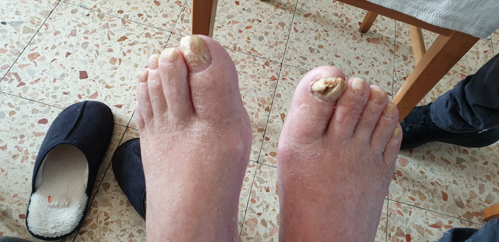 לפני הטיפול