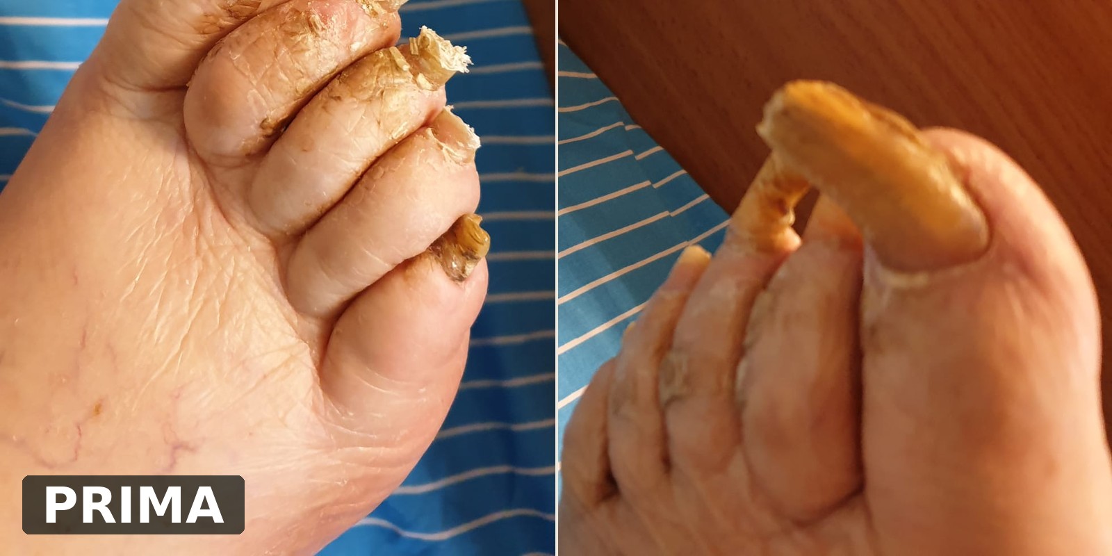 לפני הטיפול